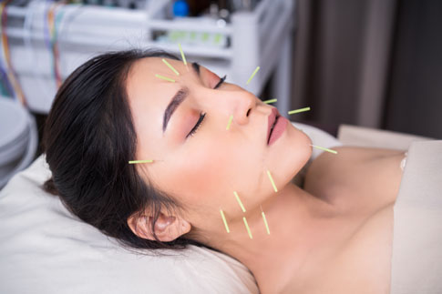 Women with acupuncture needles on face